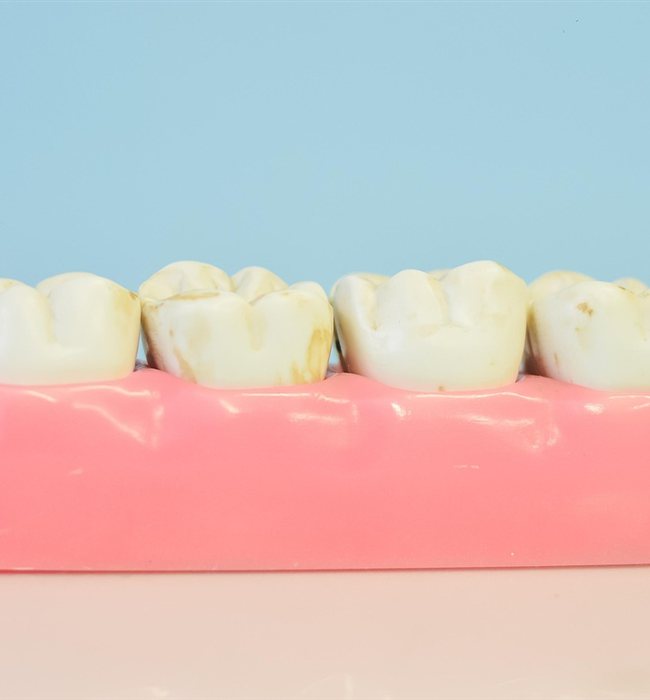 Contenzione ortodontica 3 Contenzione ortodontica