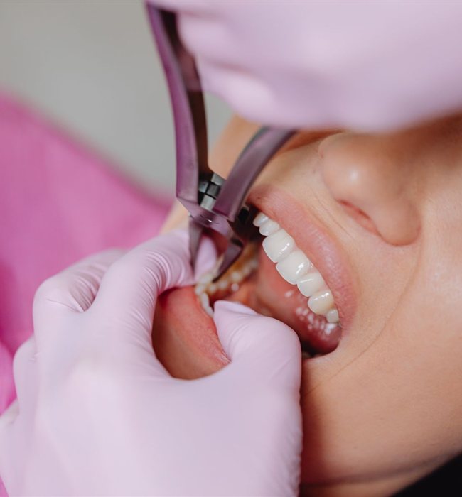 Estrazione dentale 1 Estrazione dentale